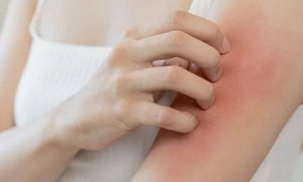 Bị mề đay sẽ nổi các nốt sần hình tròn có kích thước lên đến 10cm