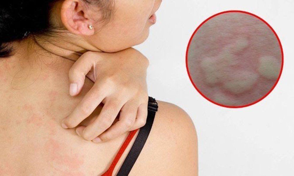 Người bệnh xuất hiện các nốt sần ngứa khi bị mề đay