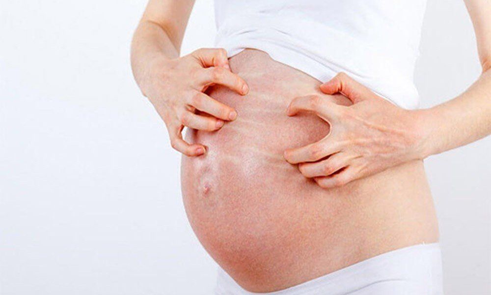 Phụ nữ mang thai bị mề đay do thay đổi nội tiết tố