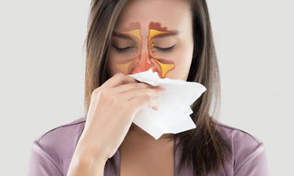 Viêm mũi VA có thể gây biến chứng viêm xoang cấp 