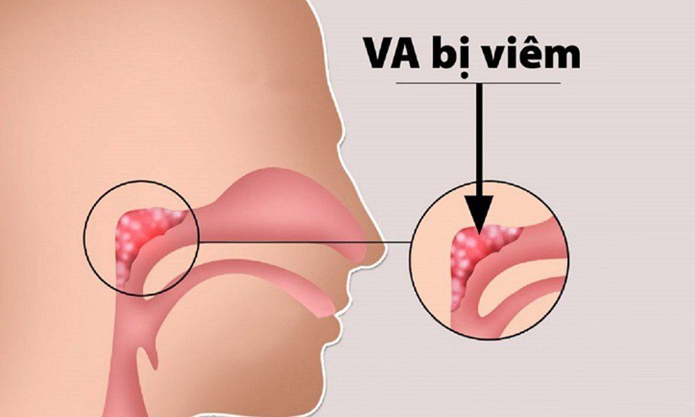Viêm mũi VA là gì